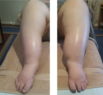 Mrs B’s daughter in her 20’s. Lipoedema inherited